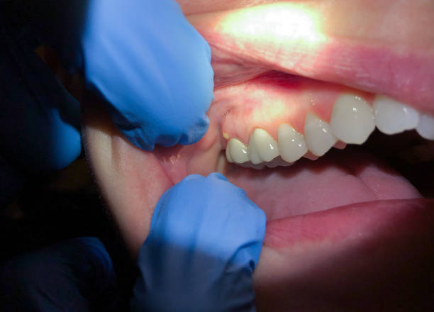 Best Emergency Treatment for Oral Infections in Old Greenwich, CT