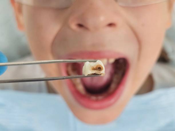 Best Knocked-Out Tooth (Avulsed Tooth) Treatment in Old Greenwich, CT